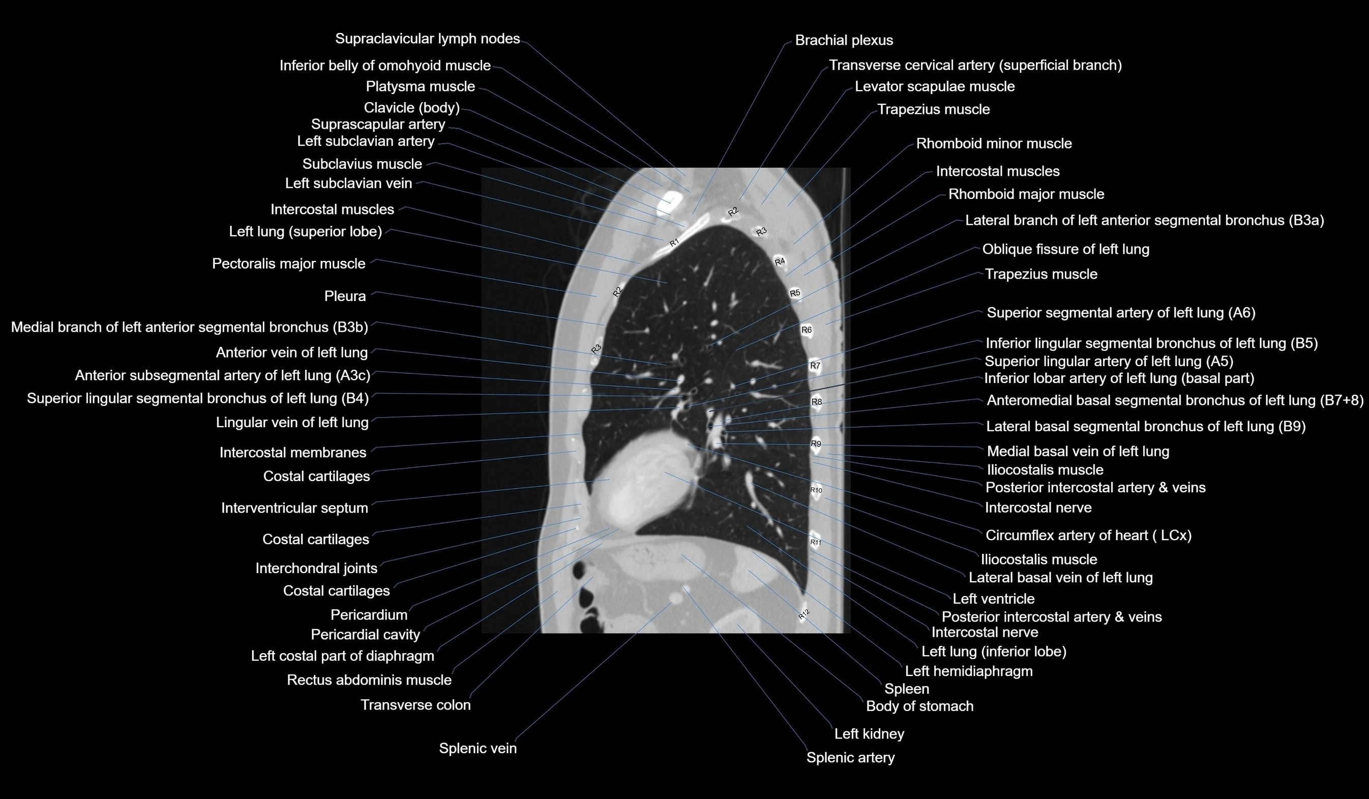 CT chest (thorax) lung window labelled sagittal cross sectional anatomy radiology image-00100.webp